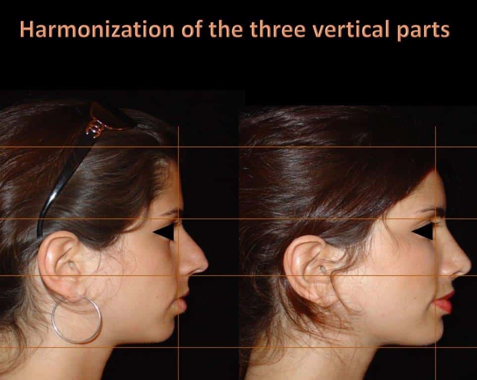 harmonisation du profil effet embellissant et rajeunissant